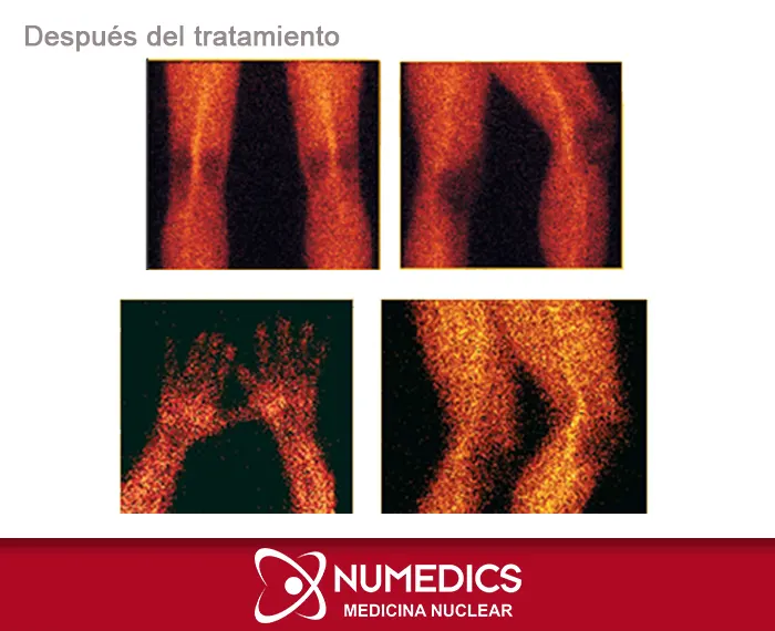 Tratamiento para artritis