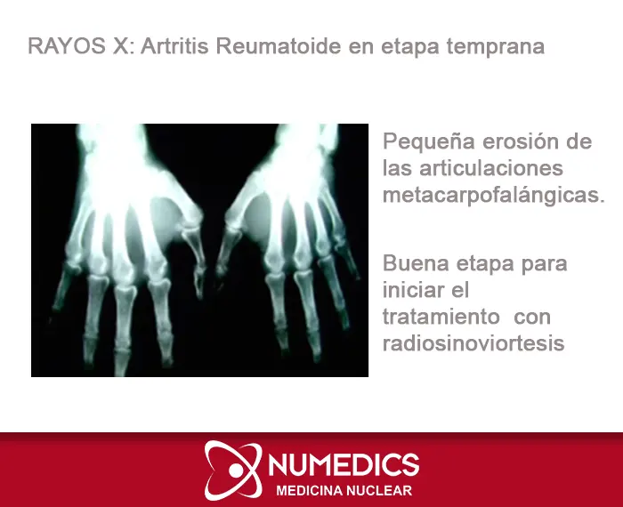 Estudio de Rayos x en etapa temprara para aplicar tratamiento (Radiosinoviortesis)