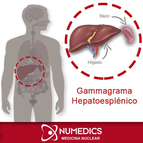 Gammagrama Hepatoesplénico