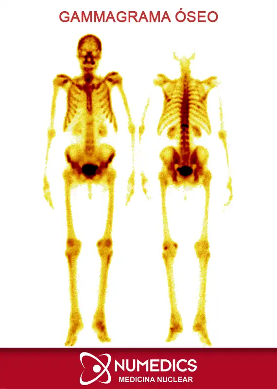 Gammagrama Óseo