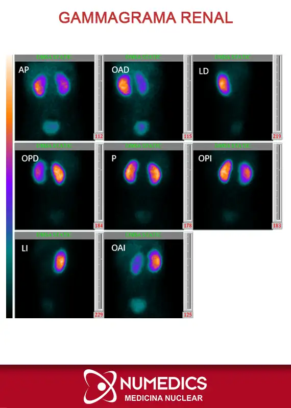 Gammagrama Renal