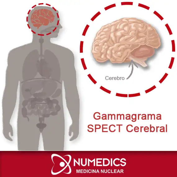 Gammagrama de perfusión cerebral