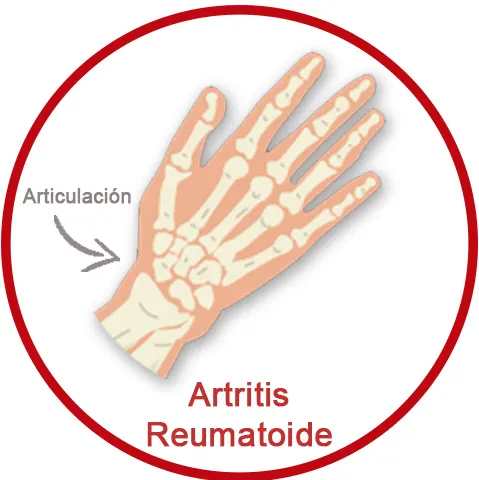Tratamiento para Artritis