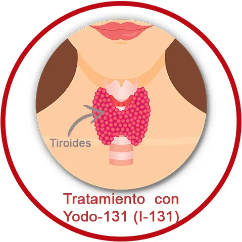 Tratamiento con Yodo-131