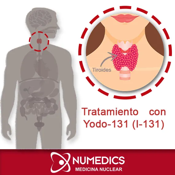 Tratamiento con Yodo-131